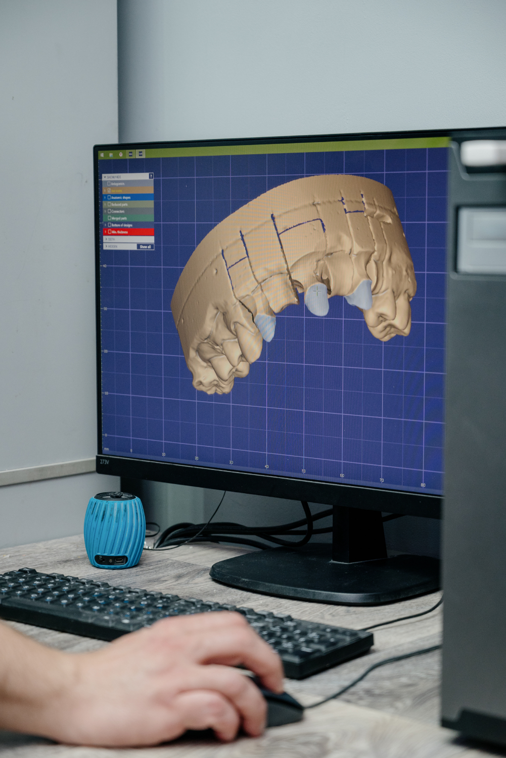 Odontología con la tecnología CAD-CAM. – Centro Odontológico de Alta ...